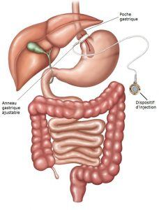 anneau-gastrique-laparoscopie