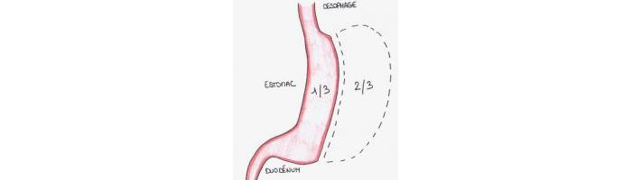 La sleeve gastrique comparée aux autres interventions bariatriques