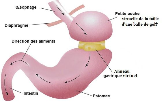 anneau-gastrique