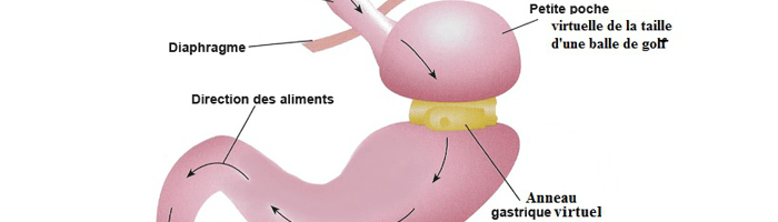 Vivre avec l’anneau gastrique (la suite)
