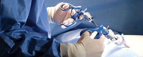 Laparoscopie : une chirurgie peu invasive