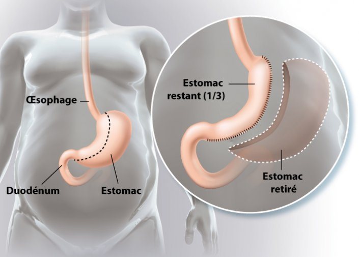 conseils avant sleeve gastrique tunisie