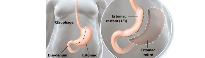 Avant la sleeve gastrique : les conseils