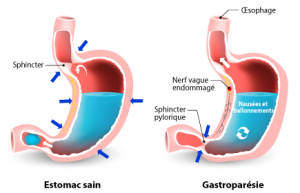 gastroparesie tunisie