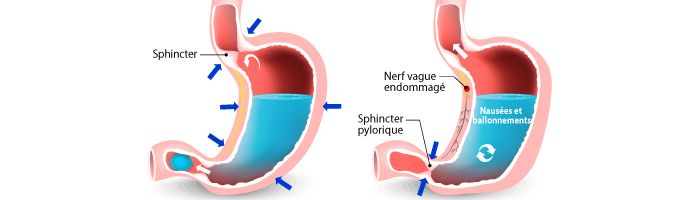 Qu’est-ce que la gastroparésie et comment la chirurgie bariatrique traite-t-elle le problème ?