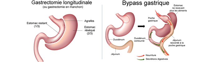 Comparatif sleeve / bypass gastrique : perte de poids et vitesse d’amaigrissement