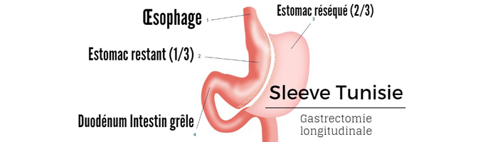 Sleeve gastrique : le choix des spécialistes