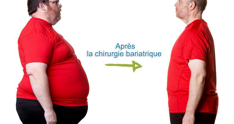 apres chirurgie bariatrique tunisie