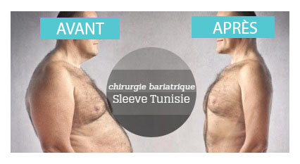 avant apres sleeve gastrectomie tunisie