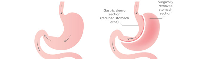 sleeve gastrique avant apres