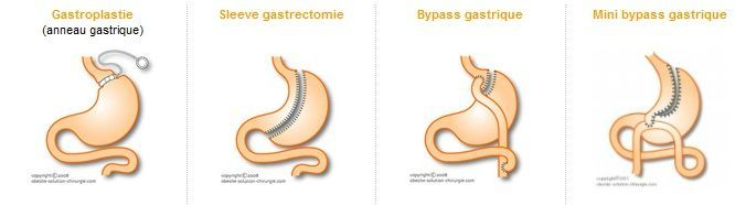 chirurgies obesites tunisie