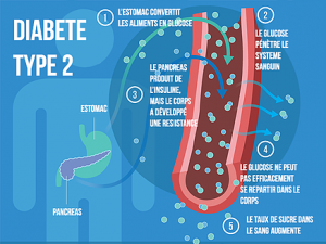 diabete type 2