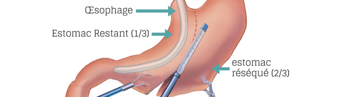 Pas d’entretien ni de soin particulier après la Sleeve gastrique, simplement de bonnes habitudes