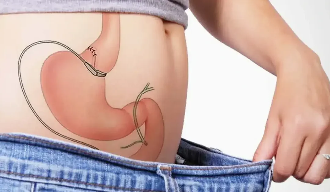 Vivre avec un anneau gastrique : à quoi faut-il s’attendre ?