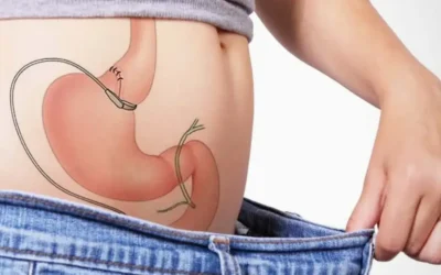 Vivre avec un anneau gastrique : à quoi faut-il s’attendre ?