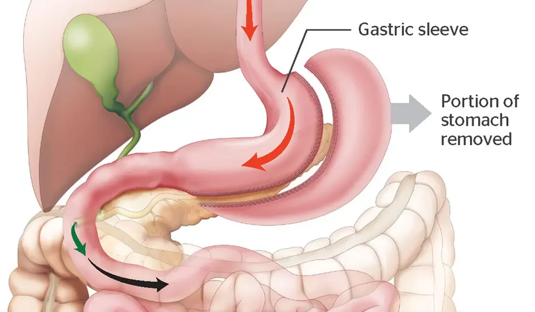 L’évolution de la sleeve gastrique