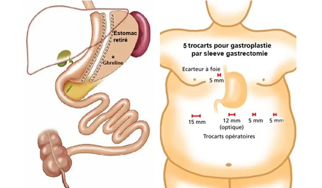 Sleeve gastrique : les résultats 1, 3, 6 et 12 mois après