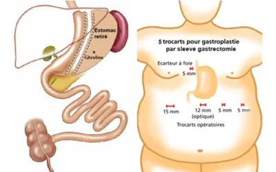 Sleeve gastrique : les résultats 1, 3, 6 et 12 mois après