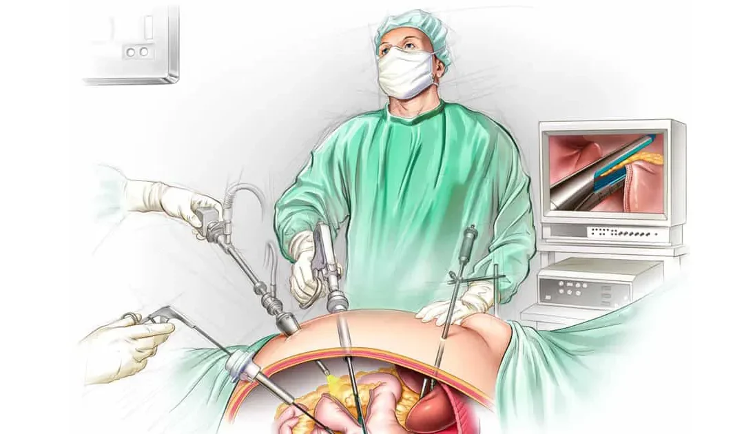 Sleeve gastrique par laparoscopie