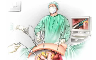 Sleeve gastrique par laparoscopie : aperçu de l&rsquo;opération