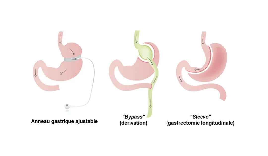 Chirurgie bariatrique endoscopique les traitements disponibles