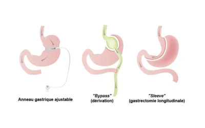 Chirurgie bariatrique endoscopique : les traitements disponibles